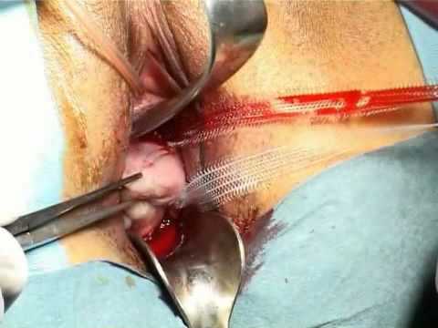 Vulvectomy - Post-Abortion Slut Fuck Vulvectomy - Post-Abortion Slut Fuck