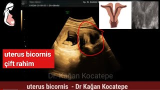Uterus bicornis, 8 haftalık gebelik. "Çift rahim" gebeliği hakkında bilgiler. Nasıl tanı konur?
