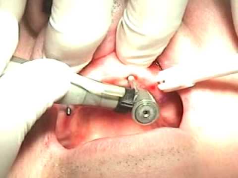 Mini Dental Implants - Mini Implant Dentures in 10 minutes!