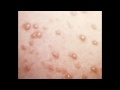 Chicken Pox SYMPTOMS and FACTS