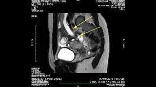 Hydronephrosis Due To Deep Endometriosis Of The Parametrium Full Time Movie
