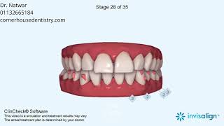 Mandibular Midline Deviation, Midline Shift, Crowding, Rotations