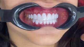 Females Teeth Makeover 4 Smile