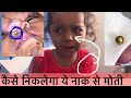 How to remove Nasal Foreign Body in Children | नाक से इतना बडा मोती कैसे निकले गा ?