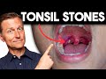 Tonsil Stones: Removing the Deeper Cause