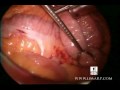 Live gastric bypass surgery - LIMARP / DR. POMPA