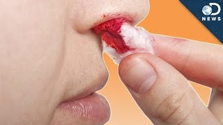Why Do We Get Nosebleeds?