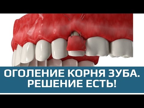 Оголенные корни зубов и их лечение Оголенные корни зубов и их лечение