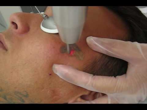 Tags:tattoo removal cost tattoo removal pricing remove tattoos