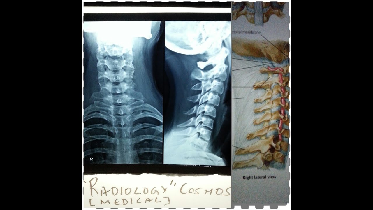 Cervical Spine X Ray and 3D Anatomy - Case of Cervical "Straightening