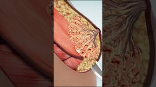 In Breast Augmentation Operation,It Is Aimed To Improve The Natural Body Dimensions Of Our Patients.