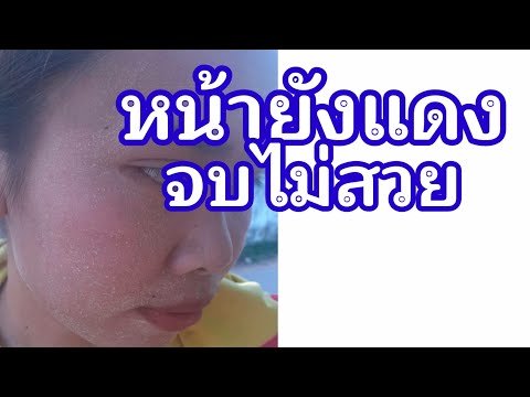EP. 77 หน้าลอกหมดแล้ว หน้าแดง แดงอึมครีม หน้าคล้ำดำ ไม่ใส (ต้องแก้แบบนี้)