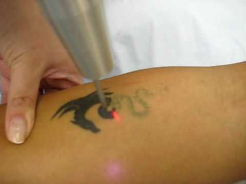 Laser Tattoo Removal by Medispa Institute in Houston, 
