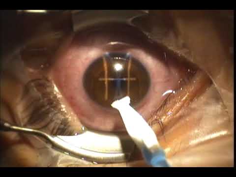 Tags:laser eye surgery epi-lasik complications epalasik epelasik benefits 