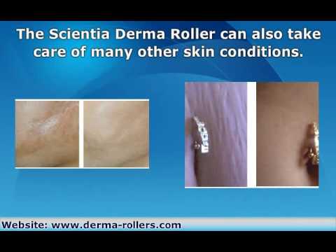 tummy tuck scars. Visit www.derma-rollers.com to see how tummy tuck scar treatment and removal can be achieved with a Scientia Derma Roller. Improve your scars, wrinkles and