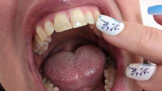 Teeth Tapping With Long Nails