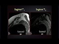 MRI of the Brachial Plexus