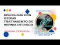 Discolisis Cervical con ozono