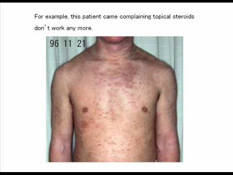 Topical steroid withdrawal psoriasis