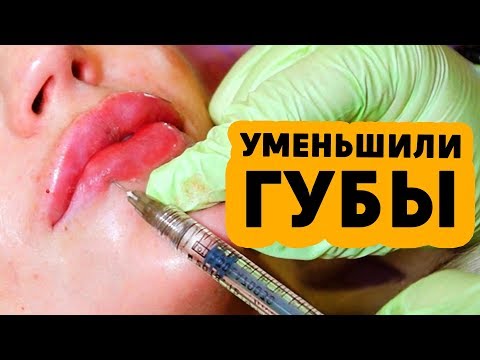 ПРОЦЕСС УДАЛЕНИЯ ГЕЛЯ ИЗ ГУБ ( ГИАЛУРОНИДАЗА ГУБ) ПРОЦЕСС УДАЛЕНИЯ ГЕЛЯ ИЗ ГУБ ( ГИАЛУРОНИДАЗА ГУБ)