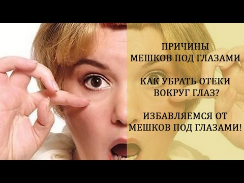 Как избавиться от отеков глаз в домашних условиях Как избавиться от отеков глаз в домашних условиях