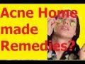 Acne Home Remedies Best Acne Treatment▬▬▬ How to get rid of Acne Naturally ▬▬▬ default Acne Home Remedies Best Acne Treatment▬▬▬ How to get rid of Acne Naturally ▬▬▬