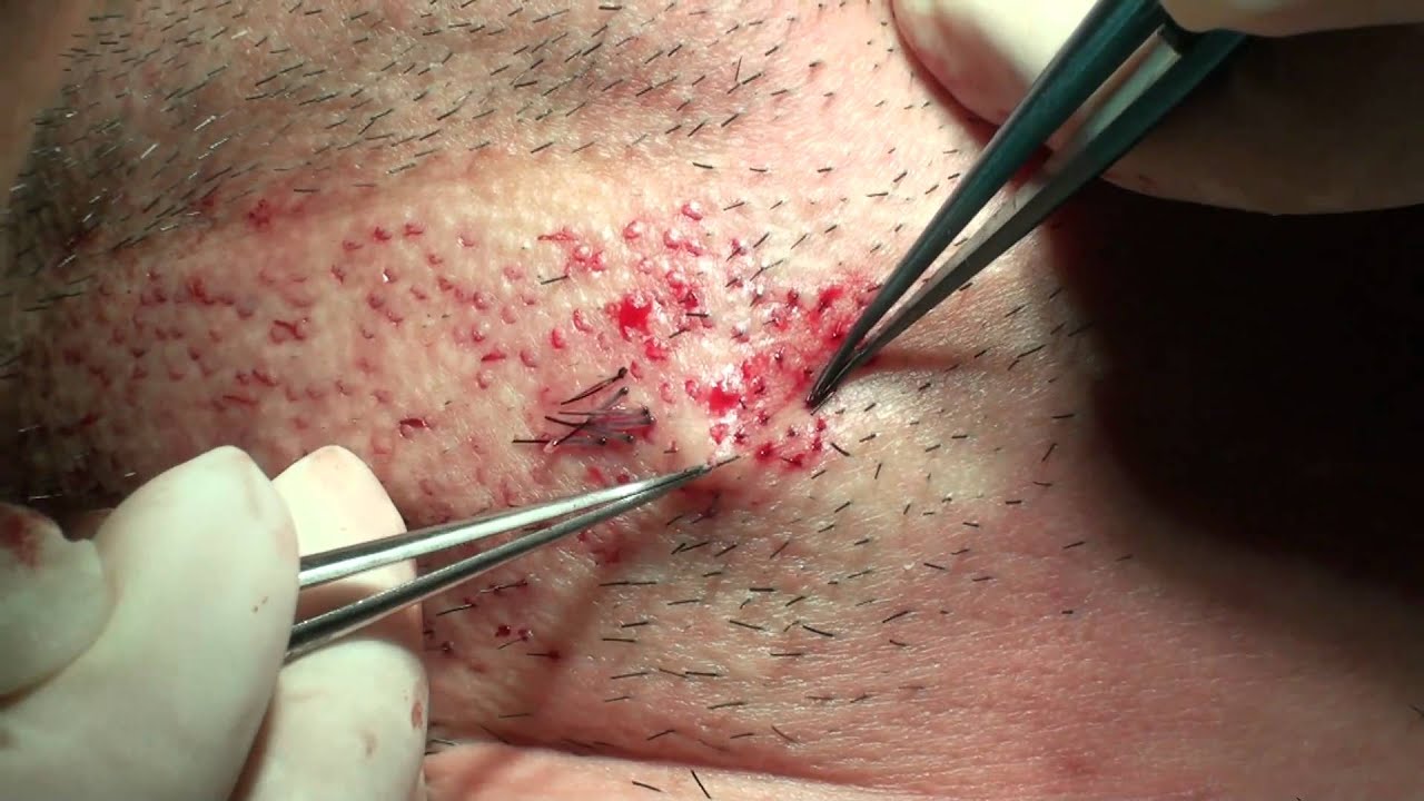 How To Pluck Your Pubic Hair | taking beard grafts out with special tweezer youtube How To Pluck Your Pubic Hair | taking beard grafts out with special tweezer youtube