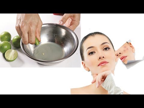 Cách trị mụn bằng chanh đơn giản tại nhà