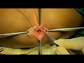 ANAL MEMBRANE - DIAGNOSIS AND SURGERY
