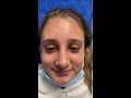 Septorhinoplasty/Sinus Surgery 12 days ago and looking good