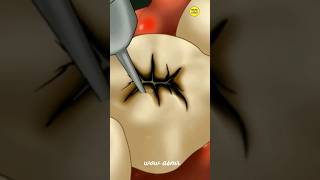 Teeth Cleaning, Teeth Cavity Cleaning Teeth Treatment Wowasmr