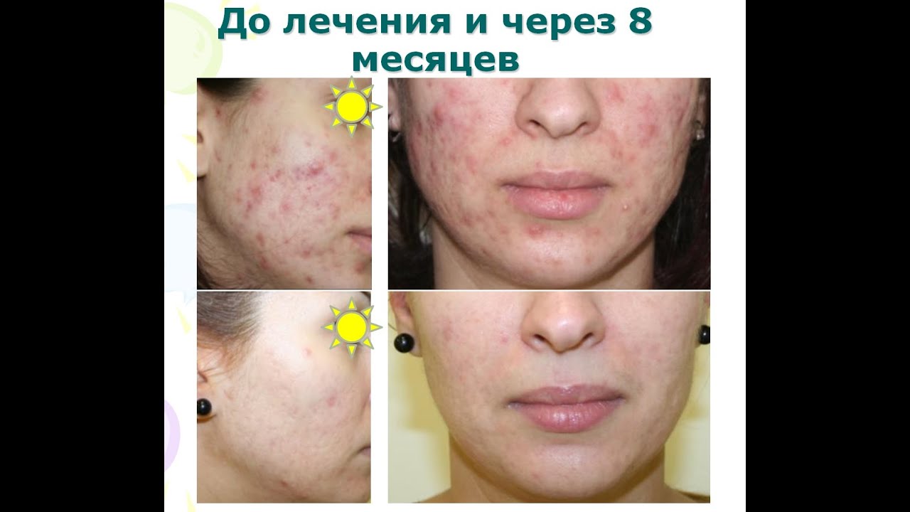 Ультразвук при акне Ультразвук при акне