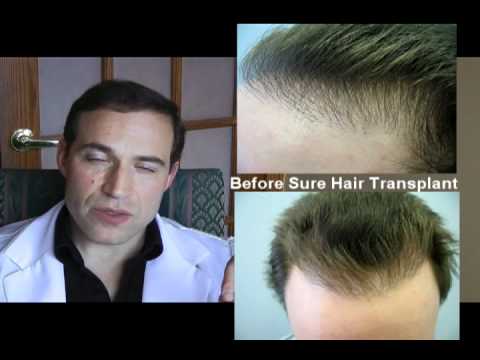 Hair Transplant Toronto on Amazing Hair Transplant Repair Toronto Canada