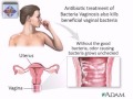 HOW TO CURE VAGINAL INFECTIONS?. (BC CURE)