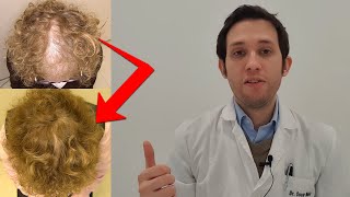 Recuperar tu pelo frontal : trasplante en mujer