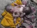 Imagen del vídeo Nacen en India siameses que comparten tronco y piernas