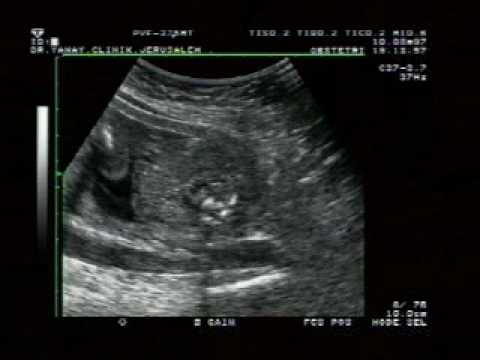 sonography test for pregnancy. How ultrasound machines work