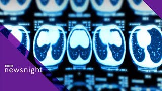 Lung cancer health checks: Do they work? - BBC Newsnight