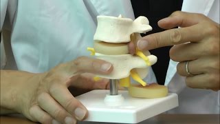椎間板ヘルニア腰椎モデル：動画