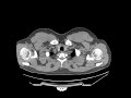 Axial 0 6mm MDCT Chest Abd Pelvis