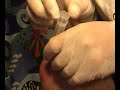 Knee Draining #2 : A must see.....