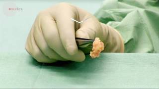 Biopsy Of Sentinel Lymph Node For Penile Cancer