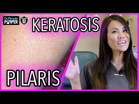 What Are These Bumps On My Skin? | Keratosis Pilaris | with Dr. Sandra Lee