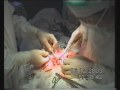Colon Surgery