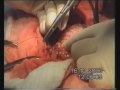 Colon Surgery