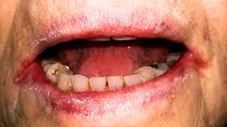 What Is Angular Cheilitis? Symptoms, Causes, Treatment