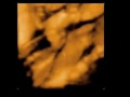 3D ultrasound