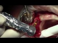 Dental Implant Live Surgery Training