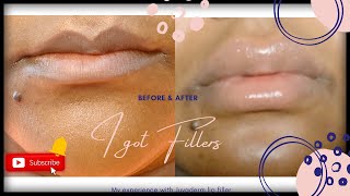 I Got Filler Before & After Juvaderm Experience