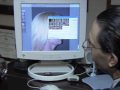 Wide Awake Short Incision Mini Face Lift with No General Anesthesia.m4v